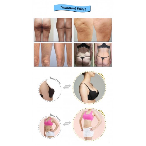  Portable 360 Cryo Cellulite Reduction Cryolipolysis Body Slimming Machine Cavitation Rf Cryo Therapy Fat Freezing Machine