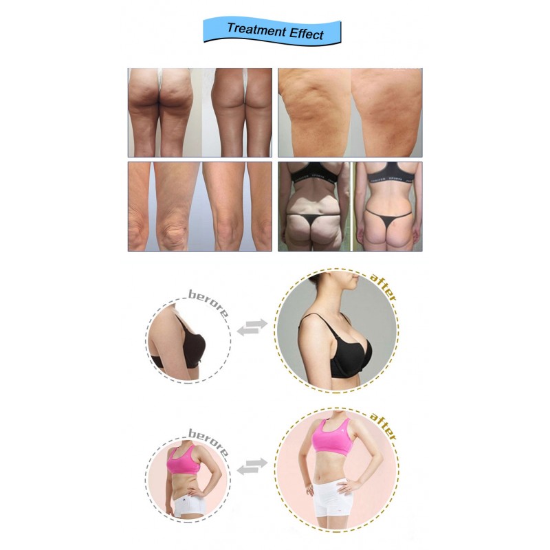  Portable 360 Cryo Cellulite Reduction Cryolipolysis Body Slimming Machine Cavitation Rf Cryo Therapy Fat Freezing Machine 